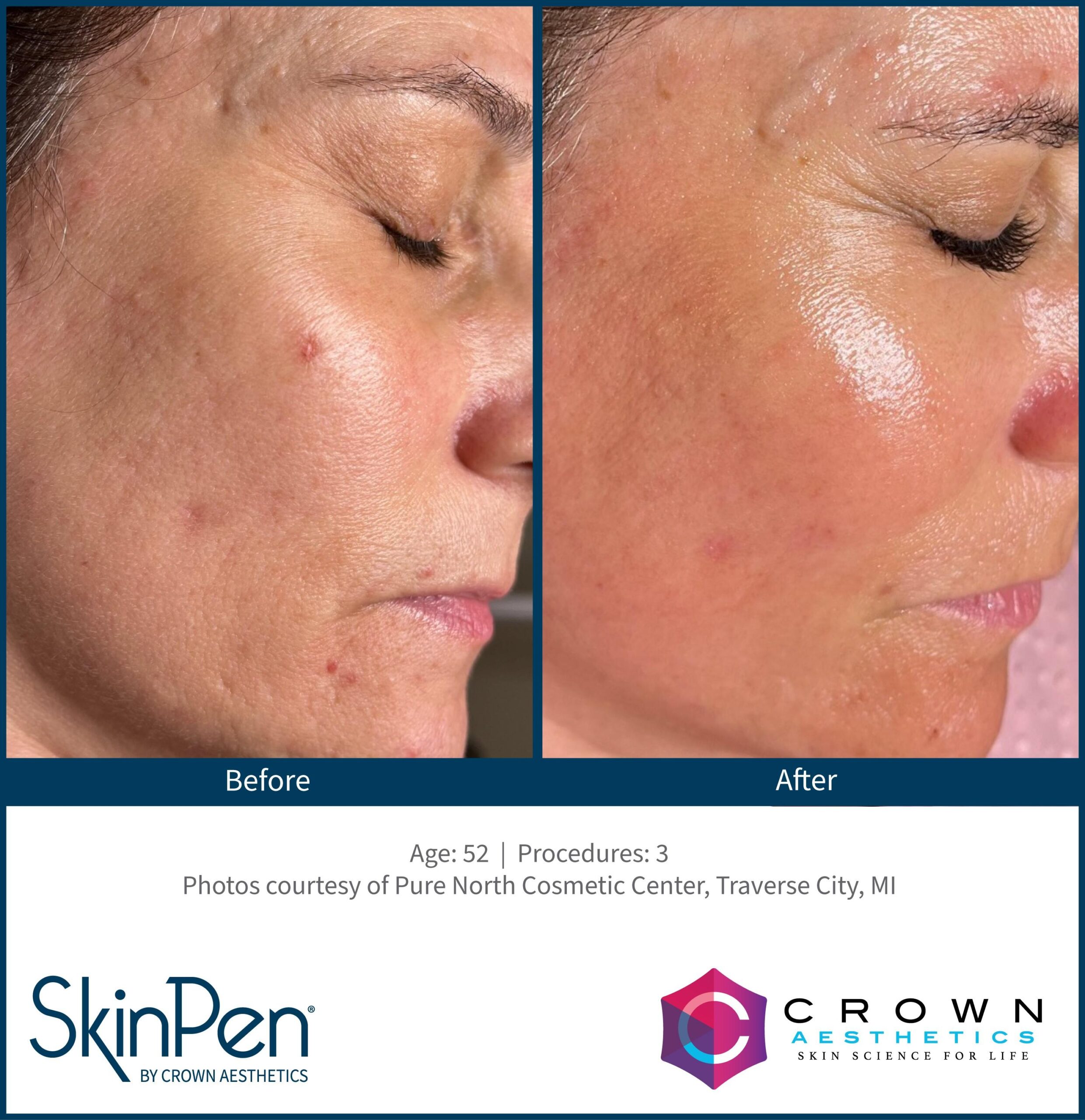 SkinPen® Microneedling 1 Beautique Medical Spa b and a traverse city 1