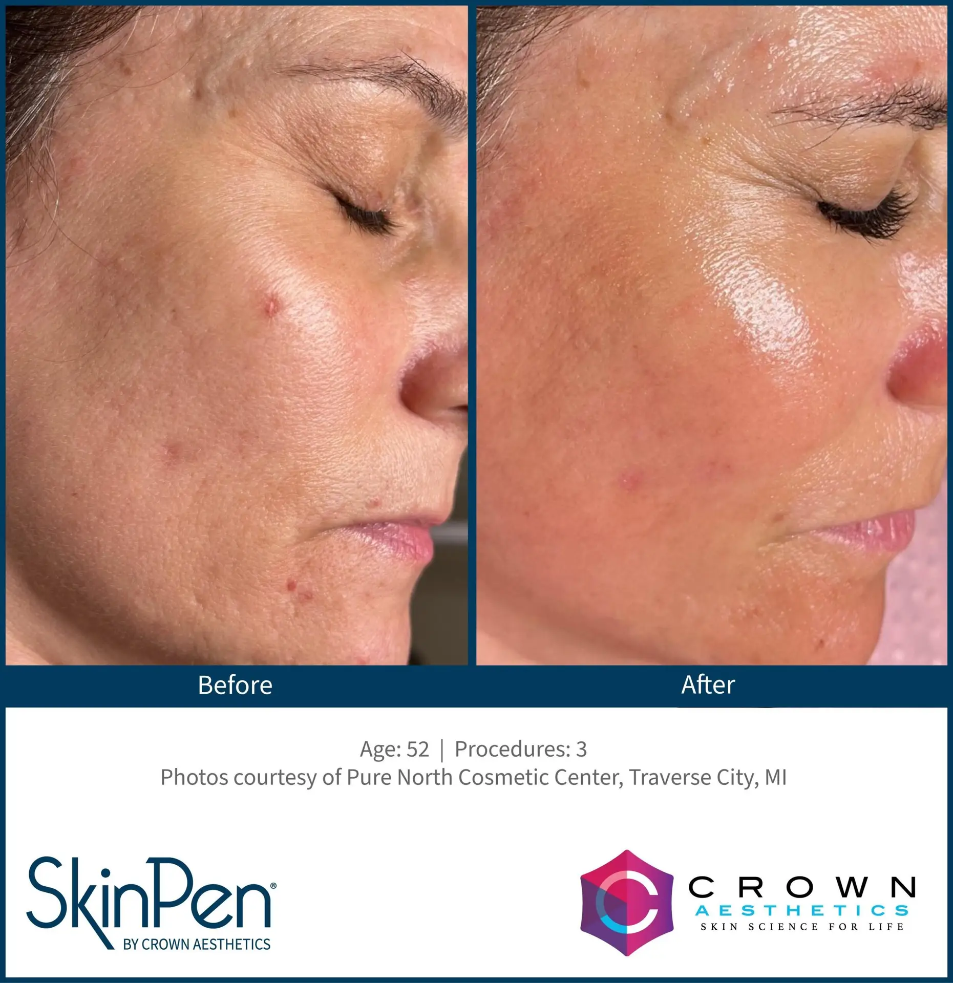 SkinPen® Microneedling 1 Beautique Medical Spa b and a traverse city 1