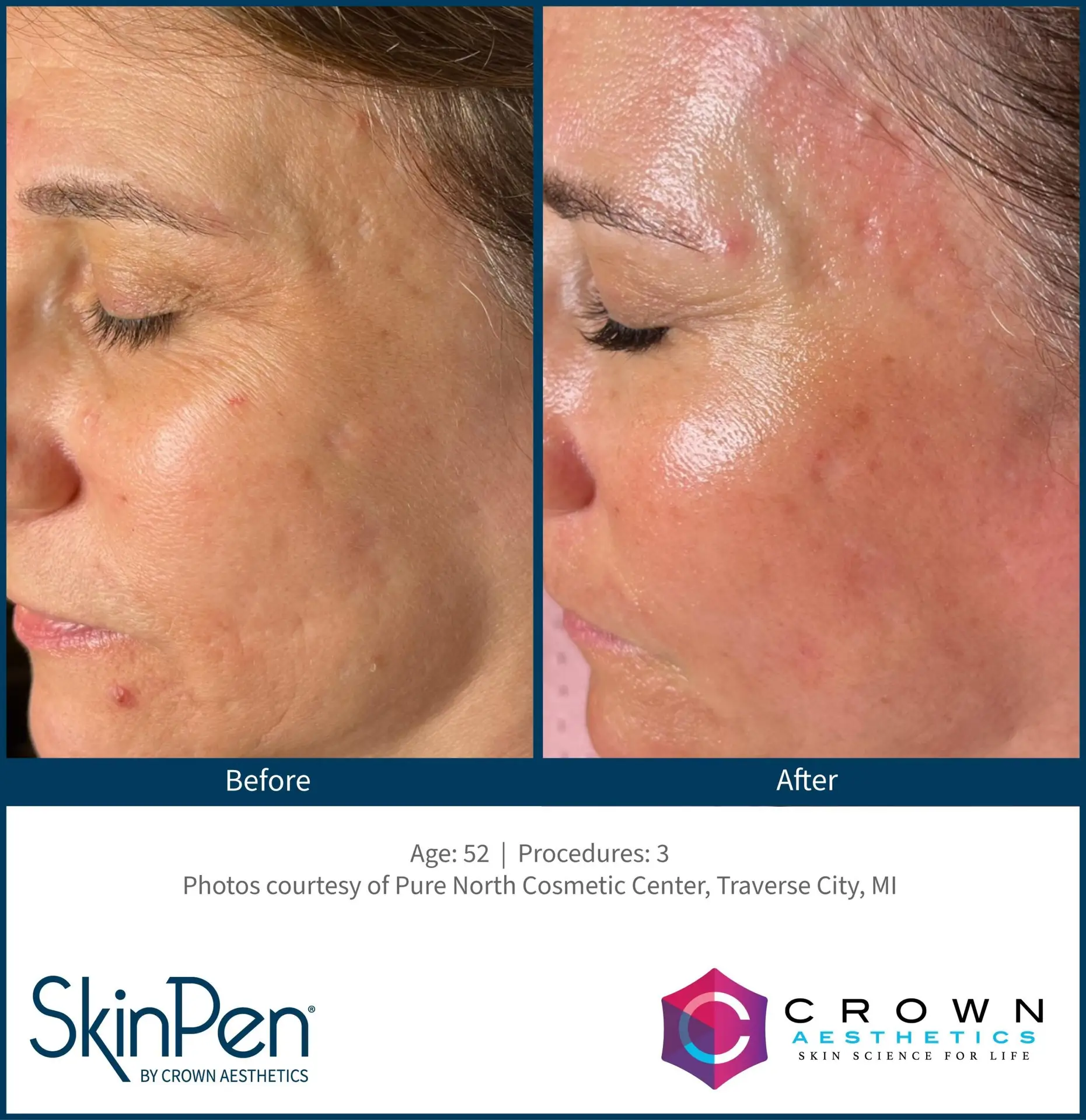 SkinPen® Microneedling 2 Beautique Medical Spa b and a traverse city 2