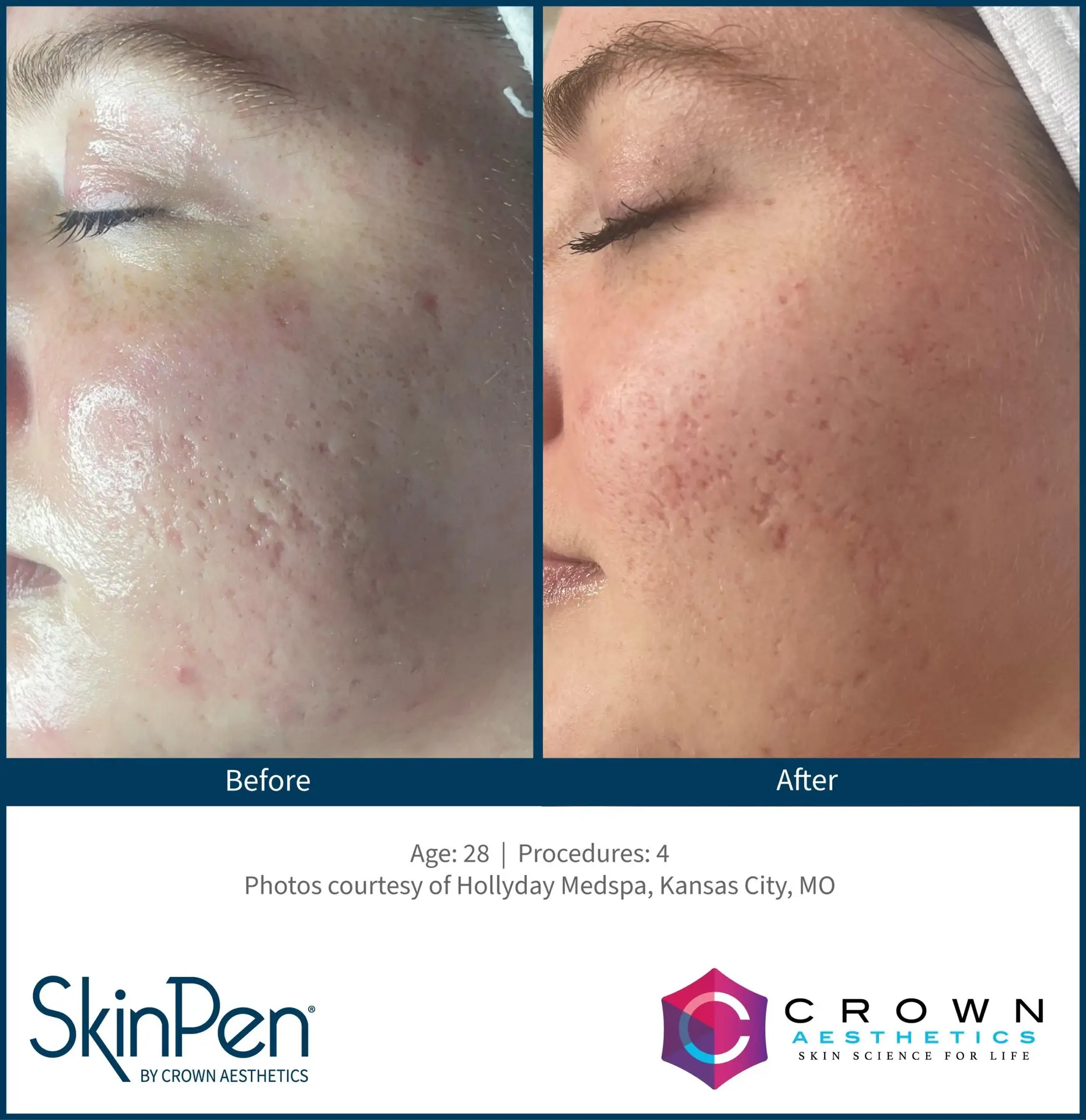 SkinPen® Microneedling 3 Beautique Medical Spa b&a