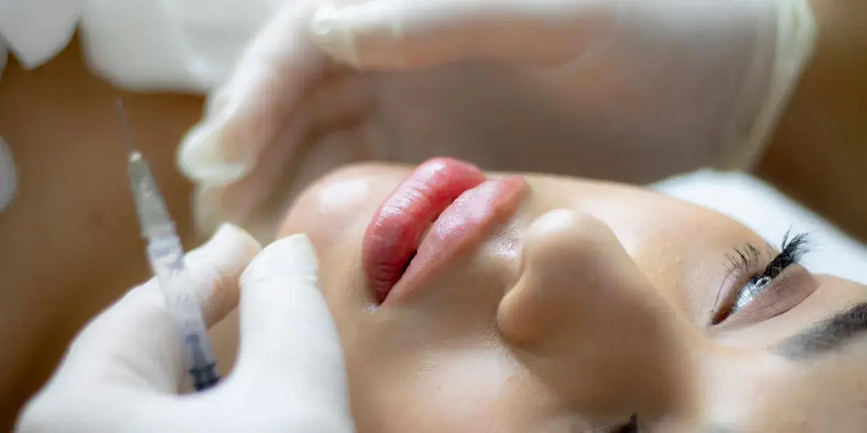 lip filler
